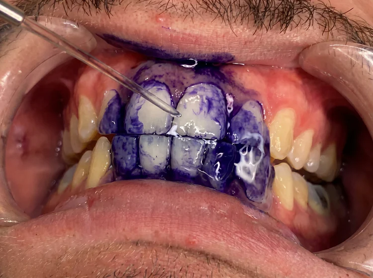 BLANQUEADOR DENTAL CIVAQ
